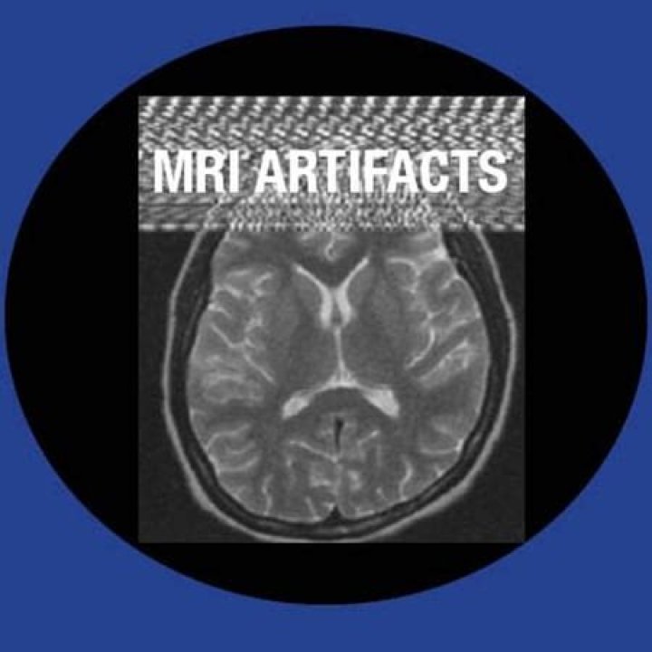 Are artifacts common on MRI