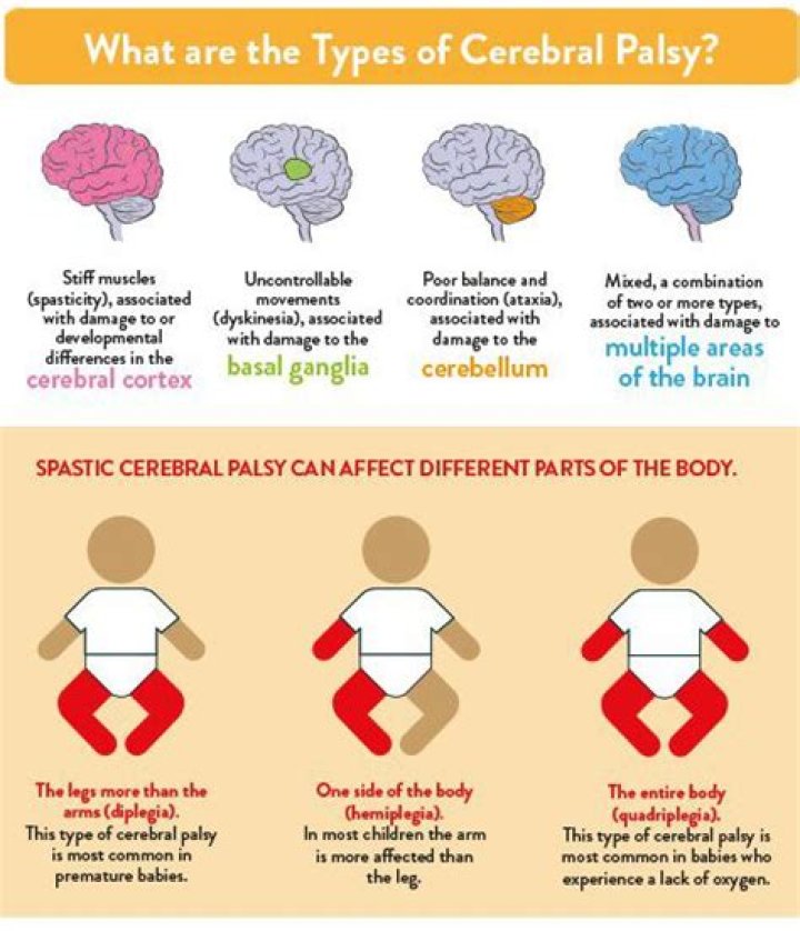 Are there different levels of cerebral palsy