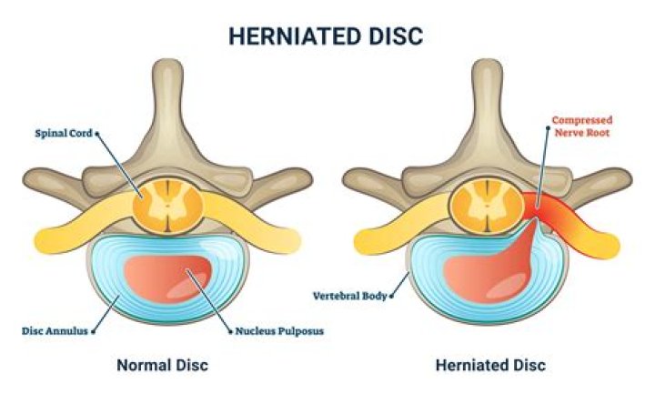 Can a hernia affect nerves