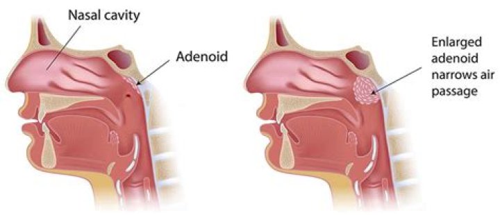 Can adenoids blocked nasal passage
