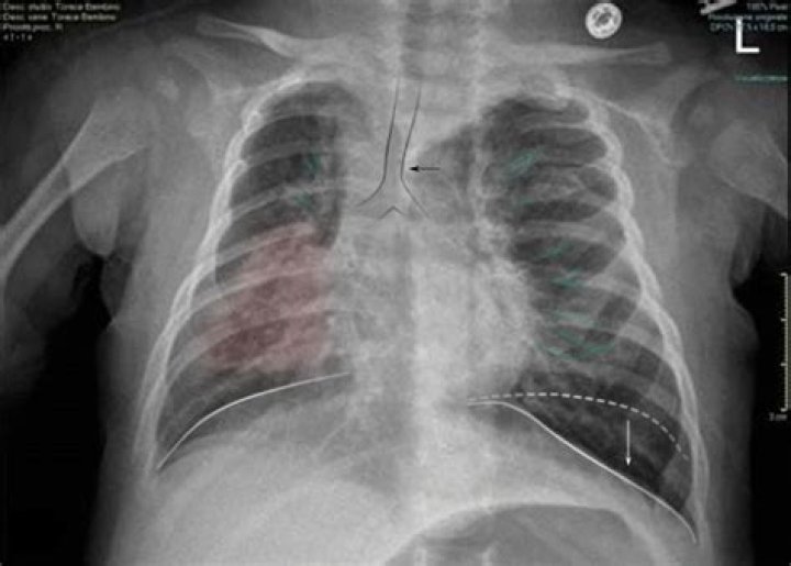 Can bronchiolitis damage lungs
