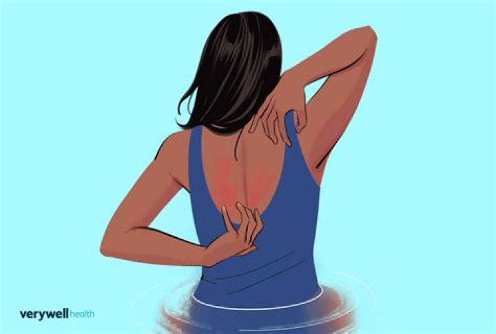 Can chlorine burn your skin