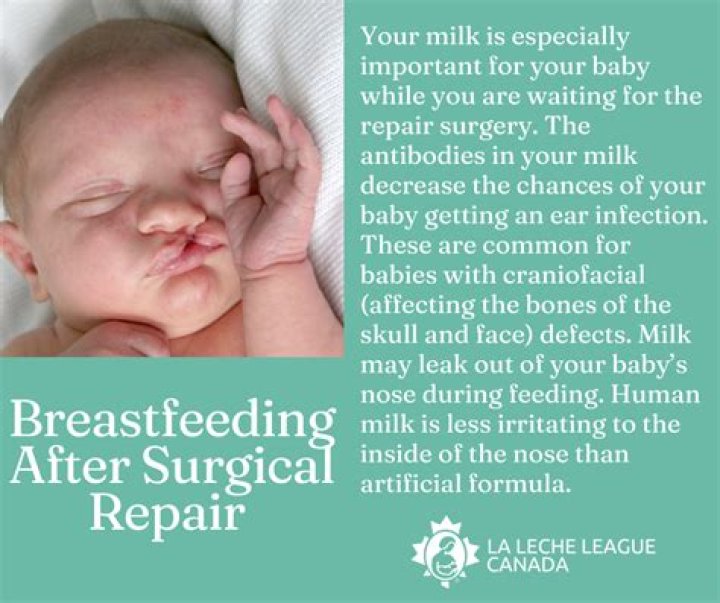 Can cleft palate babies breastfeed