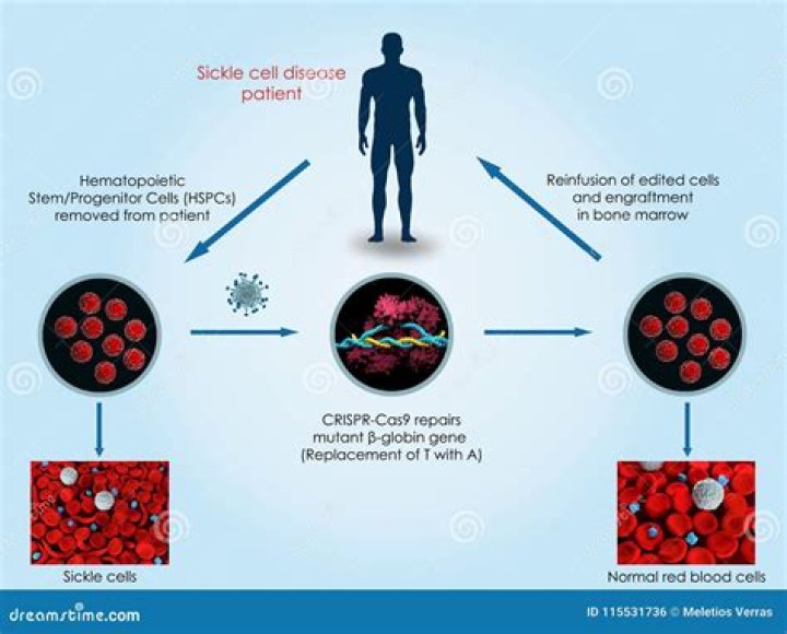 Can Crispr cure sickle cell