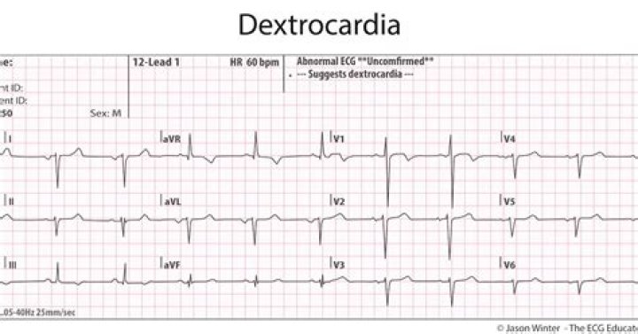 Can ECG detect dextrocardia