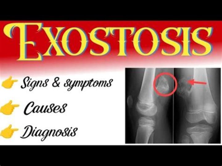 Can exostosis be cancerous