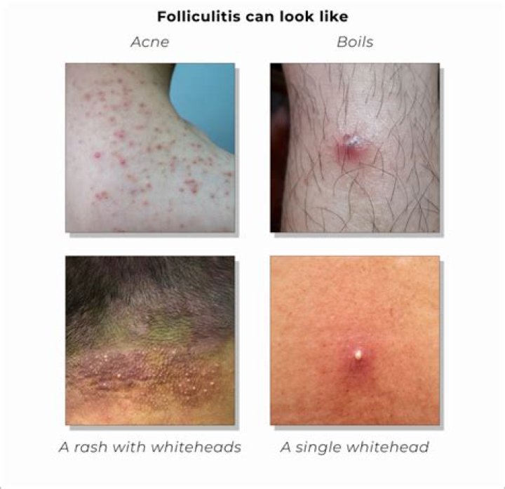 Can folliculitis spread to another person