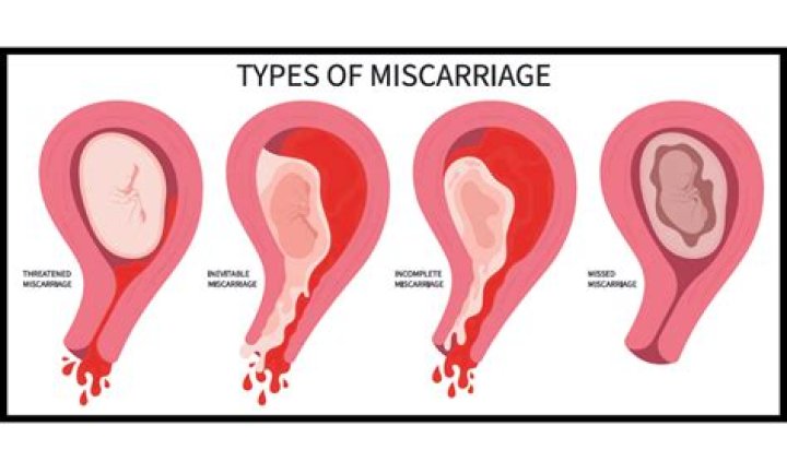 Can Geodon cause miscarriage
