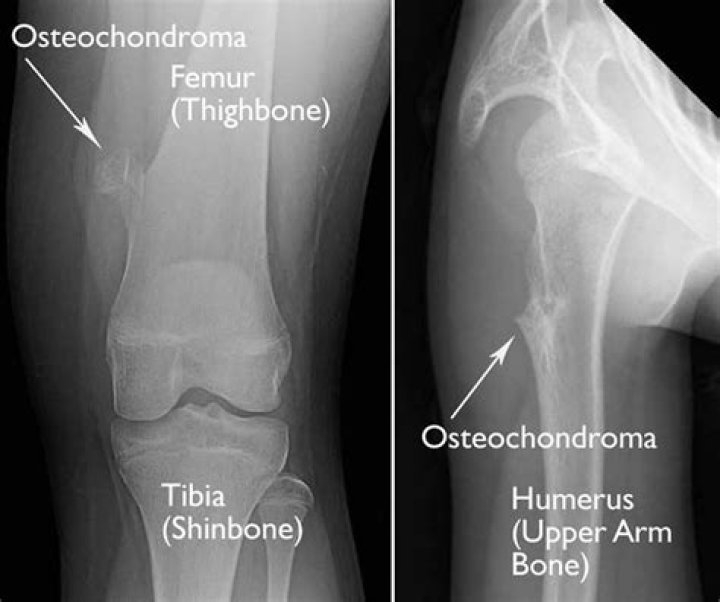Can osteochondroma be cured