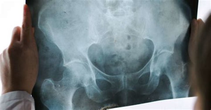 Can Phleboliths cause pain