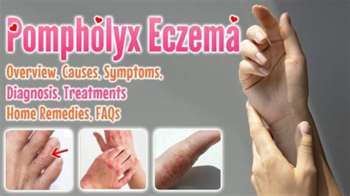 Can Pompholyx eczema spread