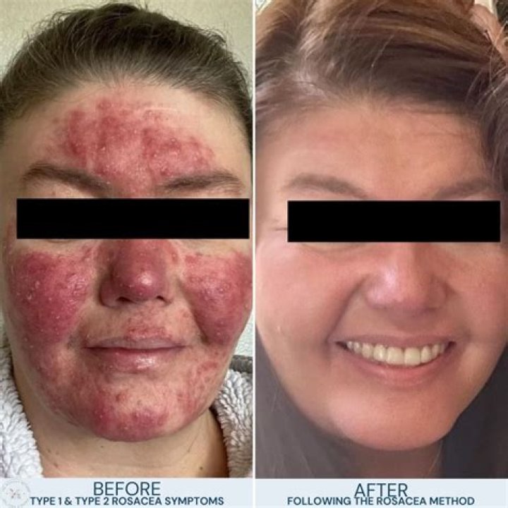 Can rosacea turn into acne