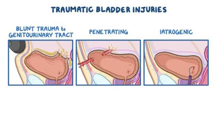 Can the bladder be repaired