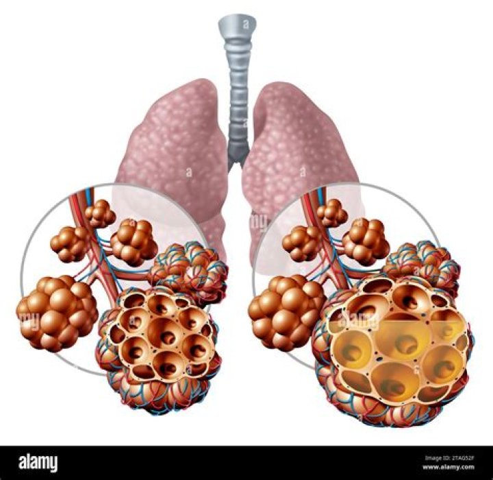 Can Too Much IV fluids cause fluid in lungs