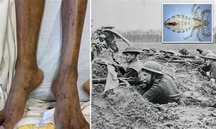 Can you die from trench fever