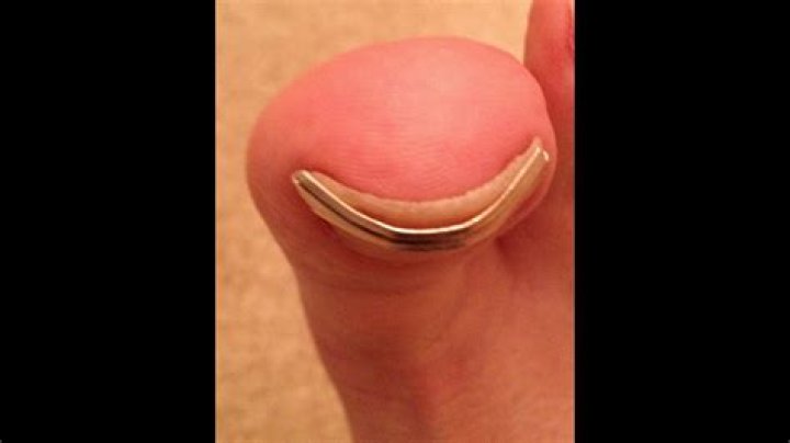 Can you fix curved toenails