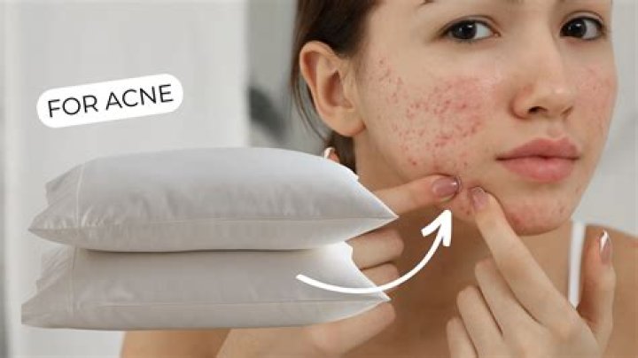 Can you get acne from pillow