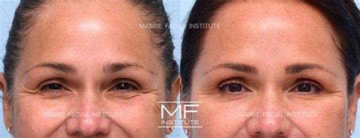 Can you put yogurt under your eyes