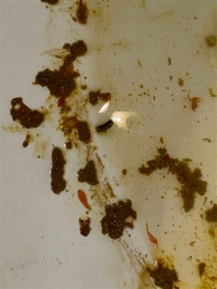 Can you see flukes in stool