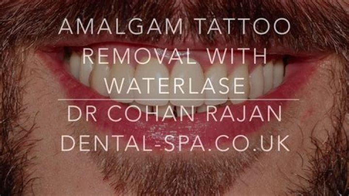 Do amalgam tattoos go away