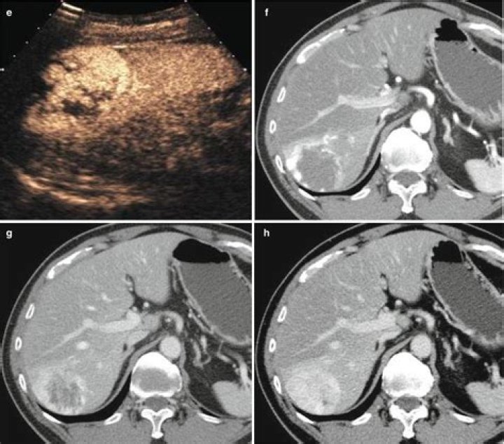 Do benign liver tumors grow