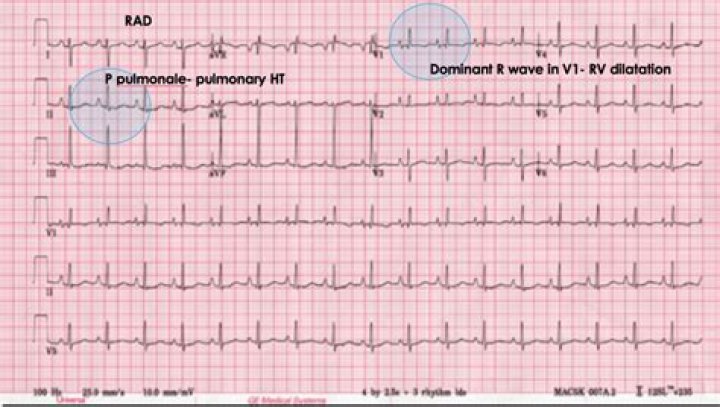 Does a PE cause tachycardia