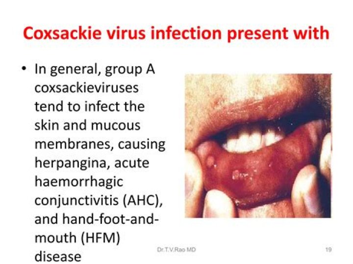 Does Coxsackie virus recur