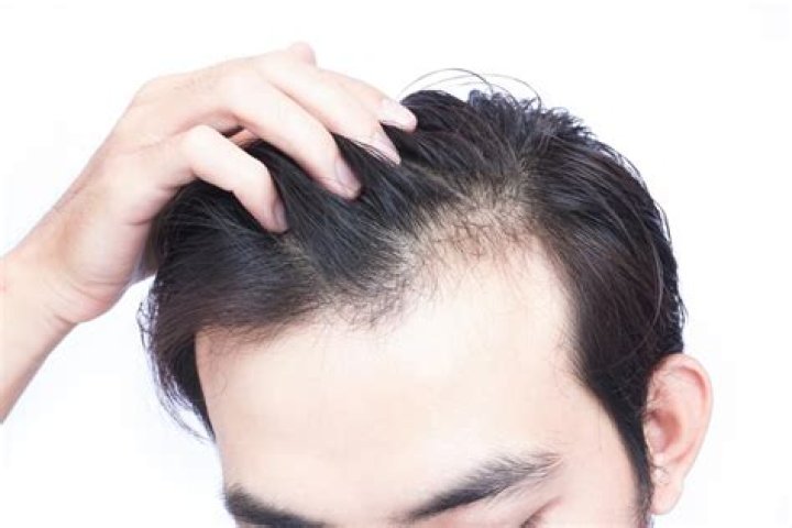 Does D Bal cause hair loss