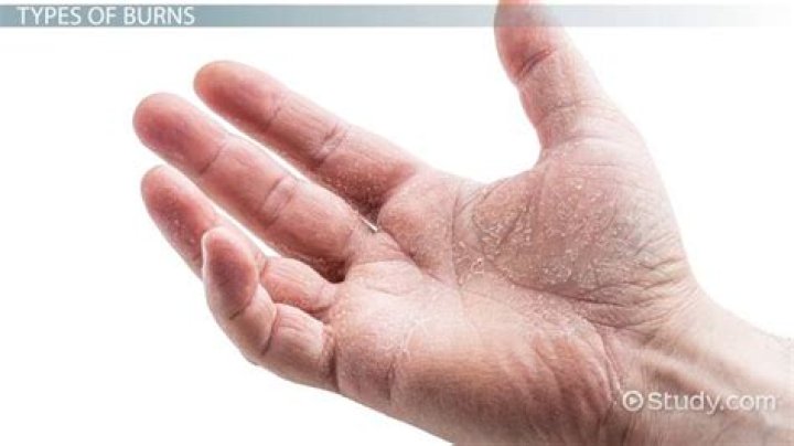 Does lime powder burn skin