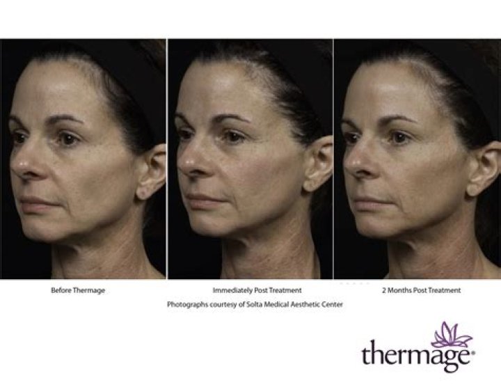 Does thermage work on face