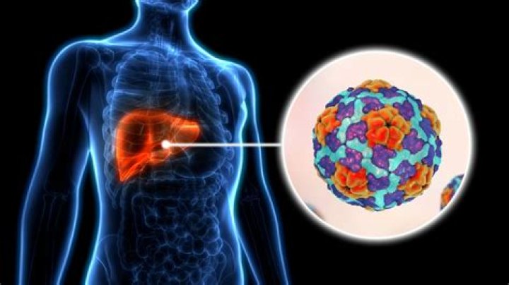 How bad is Hepatitis A