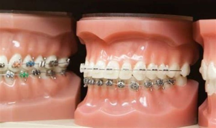 How do you apply orthodontic brackets