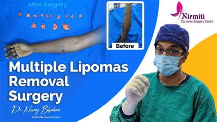 How do you code excision of multiple lipomas