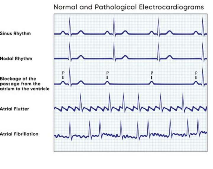 How do you describe arrhythmia