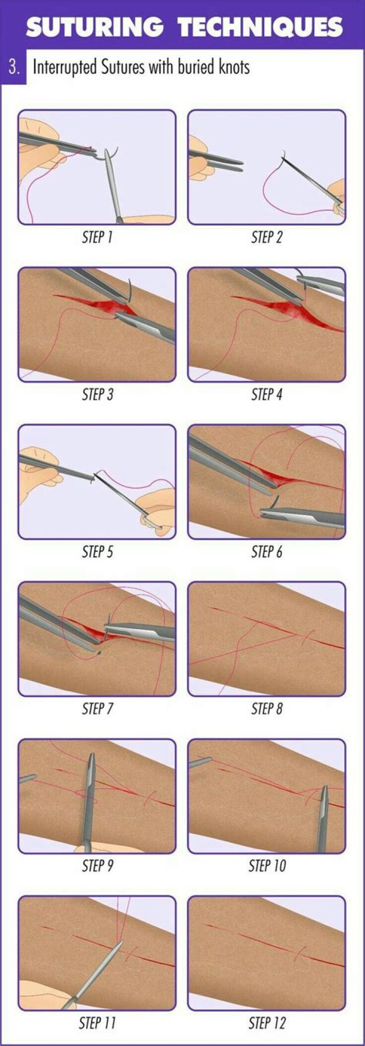 How do you suture a tendon