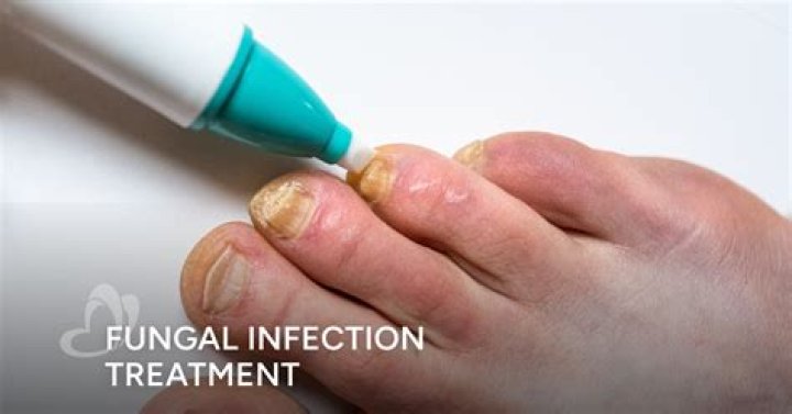 How do you treat a fungal infection in the mouth