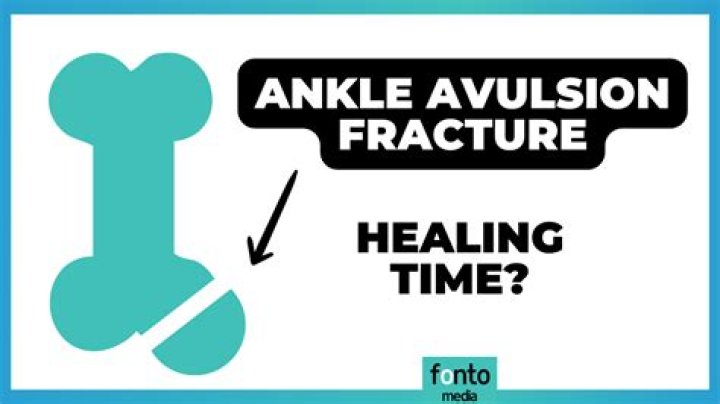 How do you treat an avulsion fracture