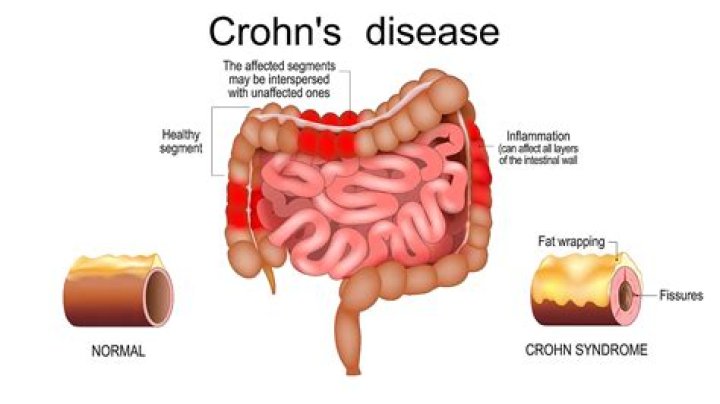 How does Crohns disease feel