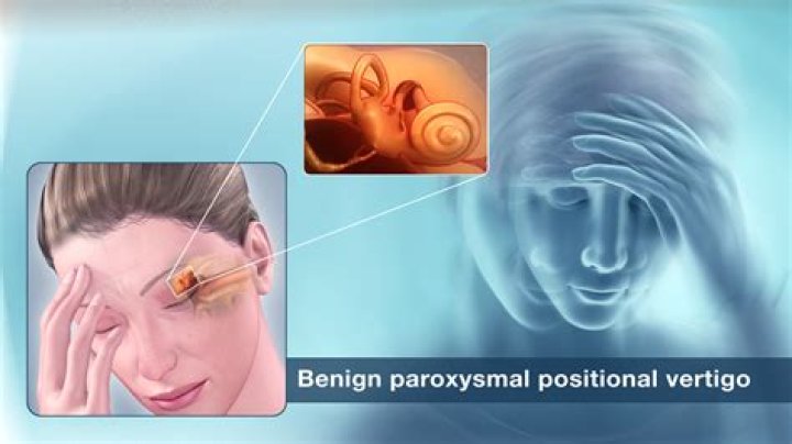 How is benign positional vertigo diagnosed