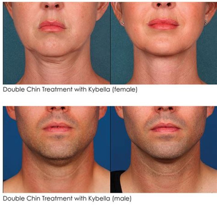 How long are you swollen after Kybella