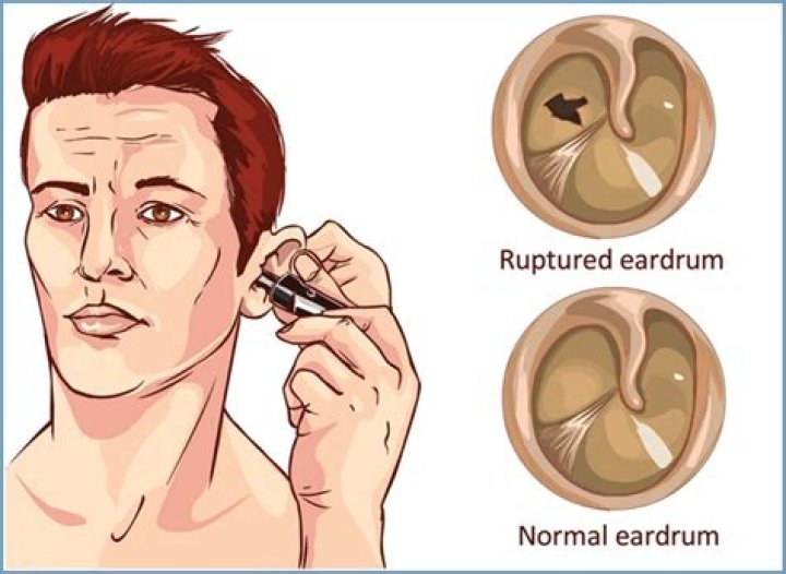 How long does a bulging eardrum take to heal