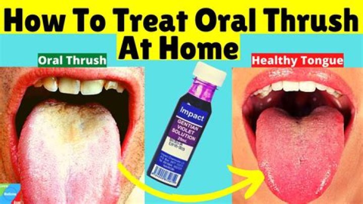How long should I take Nystatin for oral thrush