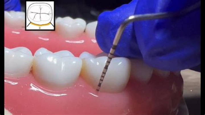How often should you perio probe