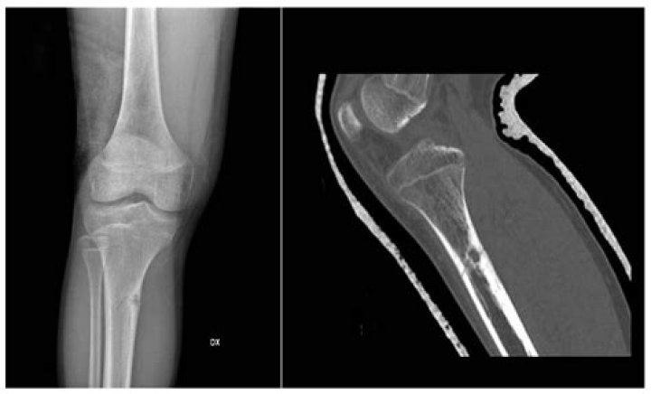 Is a benign lesion a tumor