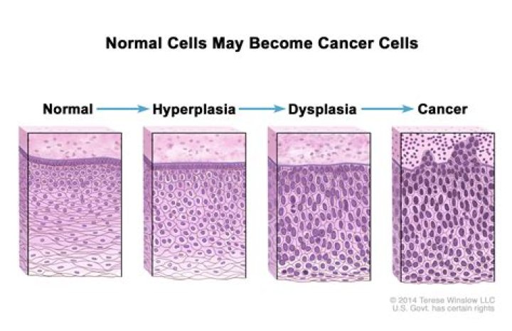 Is dysplasia the same as cancer