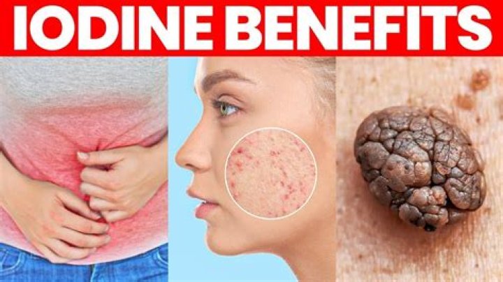 Is iodine good for pimples