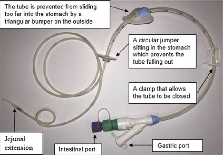 Is J Tube same as PEG tube