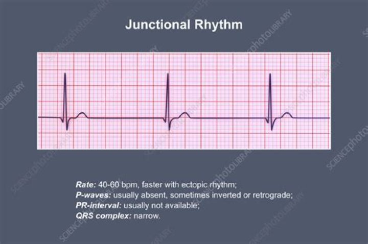 Is junctional rhythm normal
