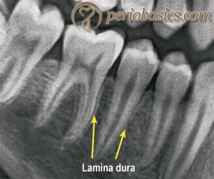 Is lamina dura radiolucent