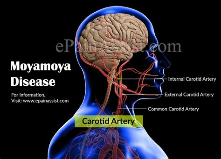 Is Moyamoya disease curable